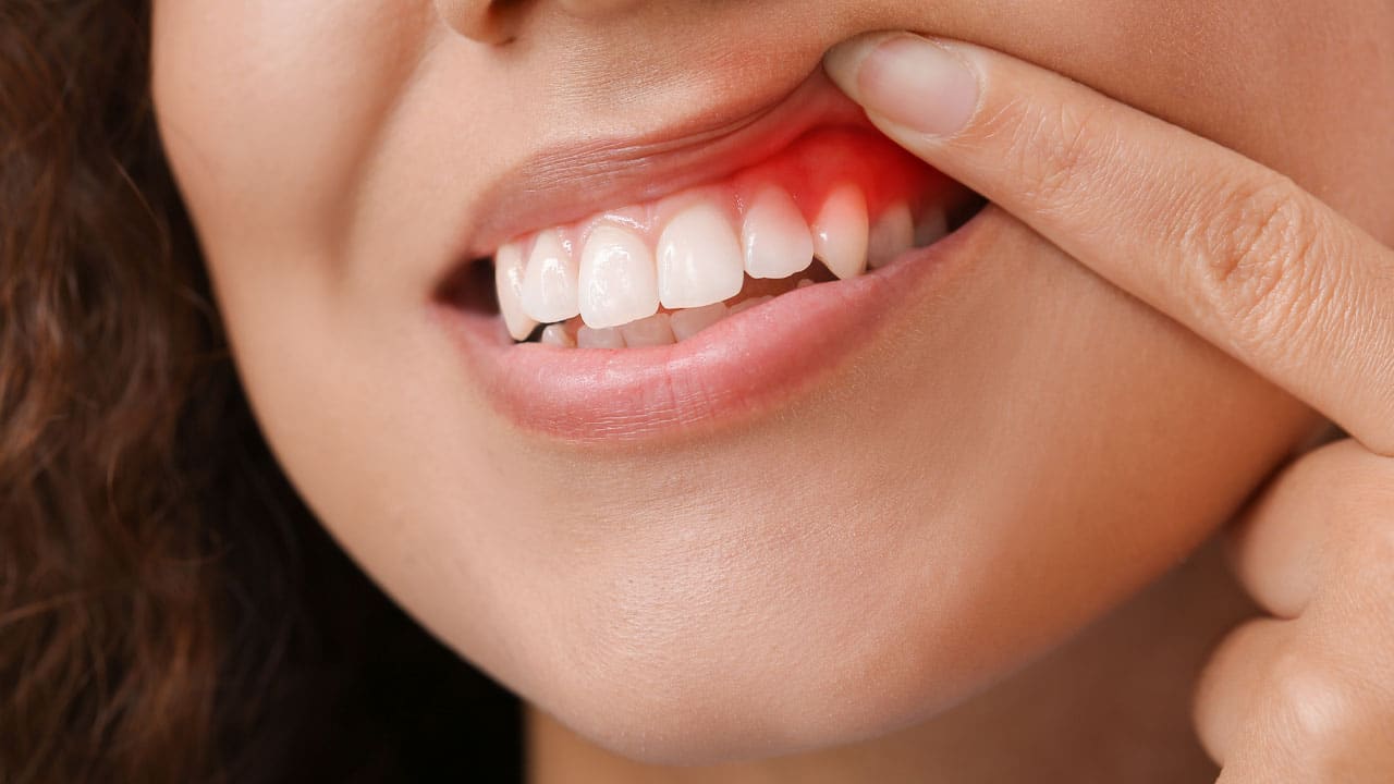 Woman pointing to inflamed part of her gums