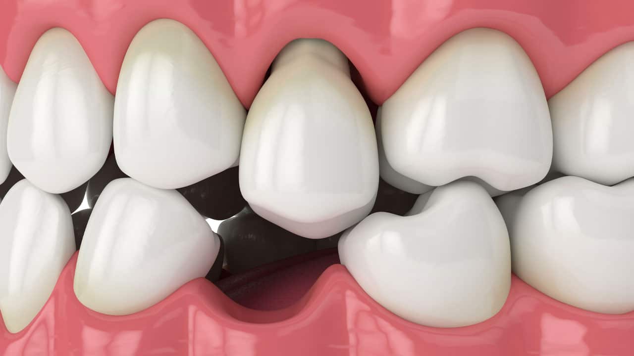 3D rendering of a mouth missing a tooth