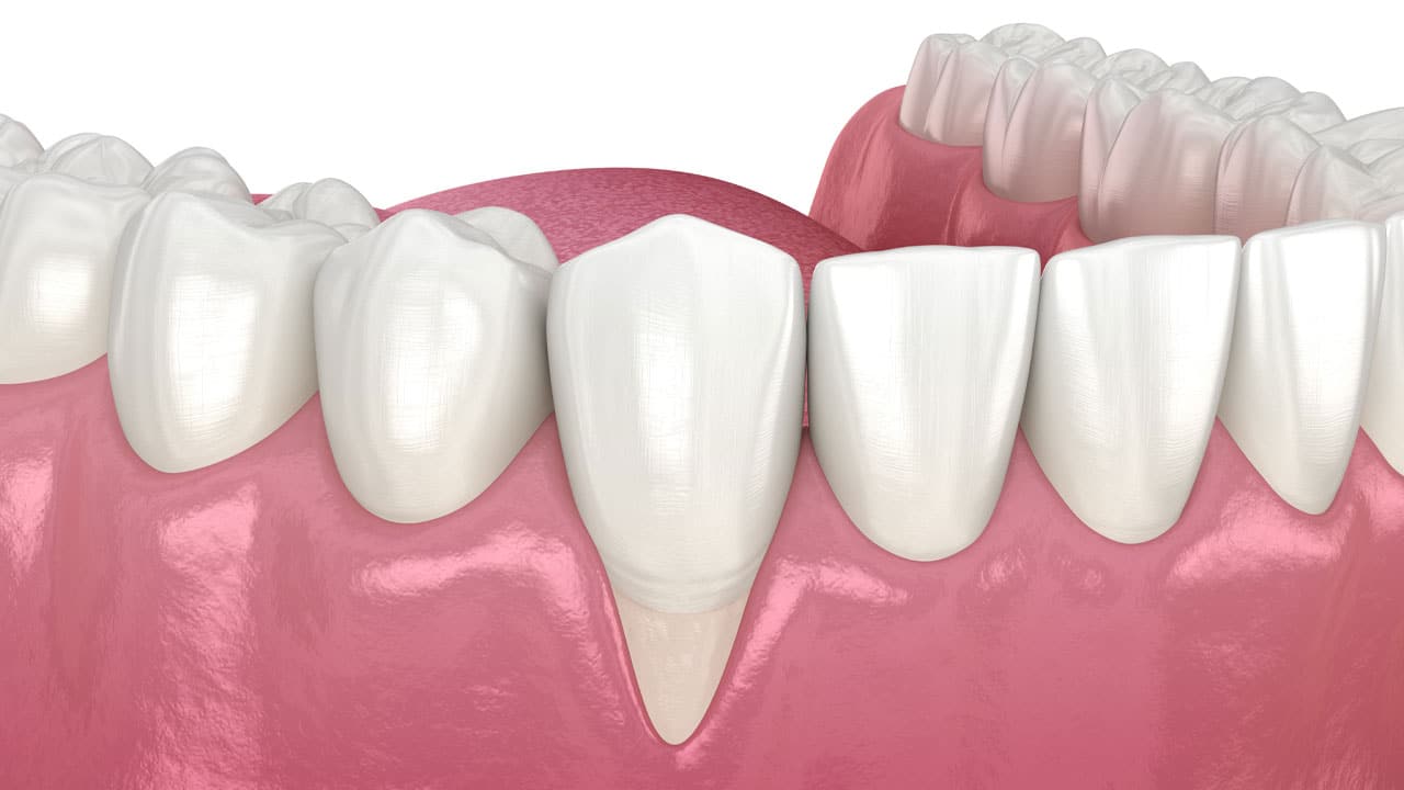 3D render of gum disease shown in a model of a mouth
