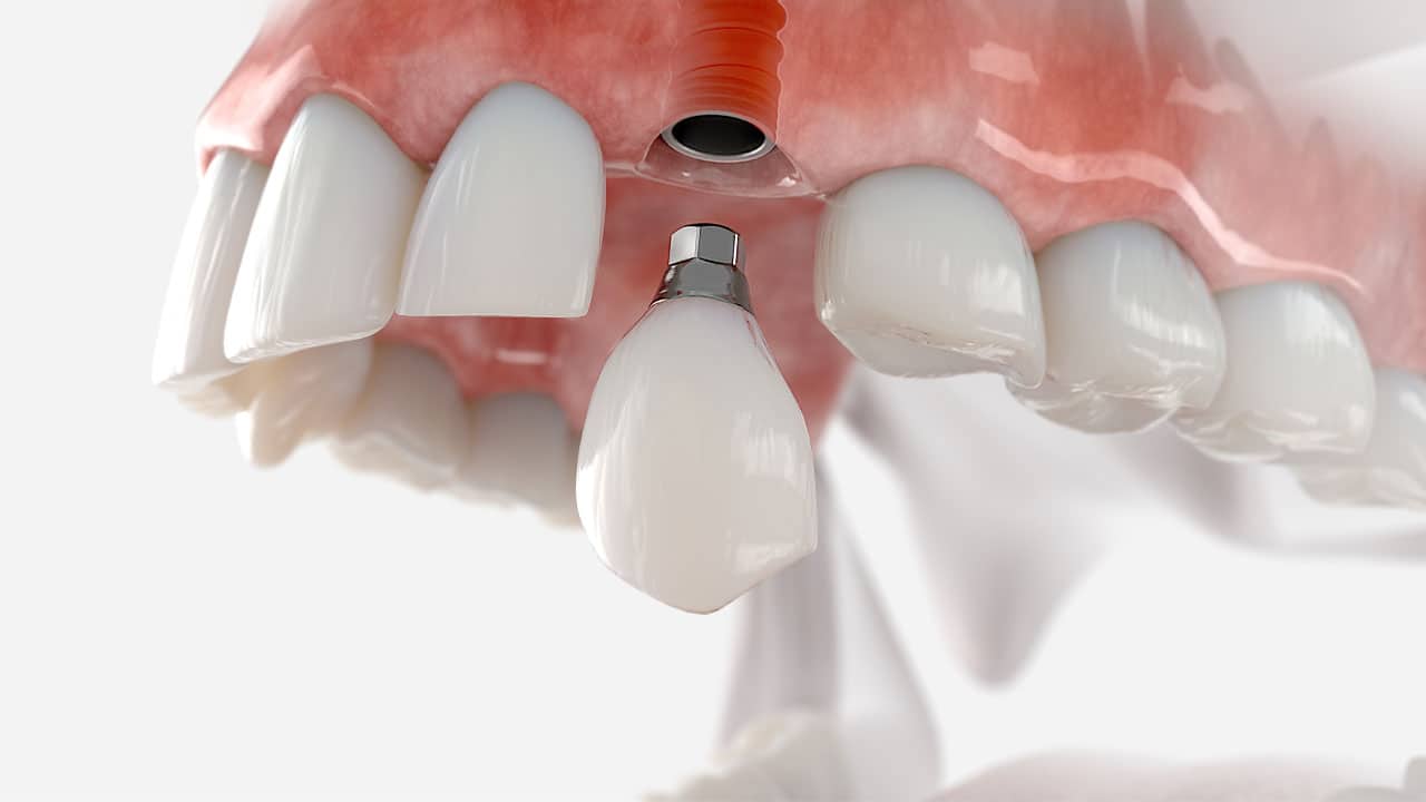 3d rendering of a dental implant in mouth