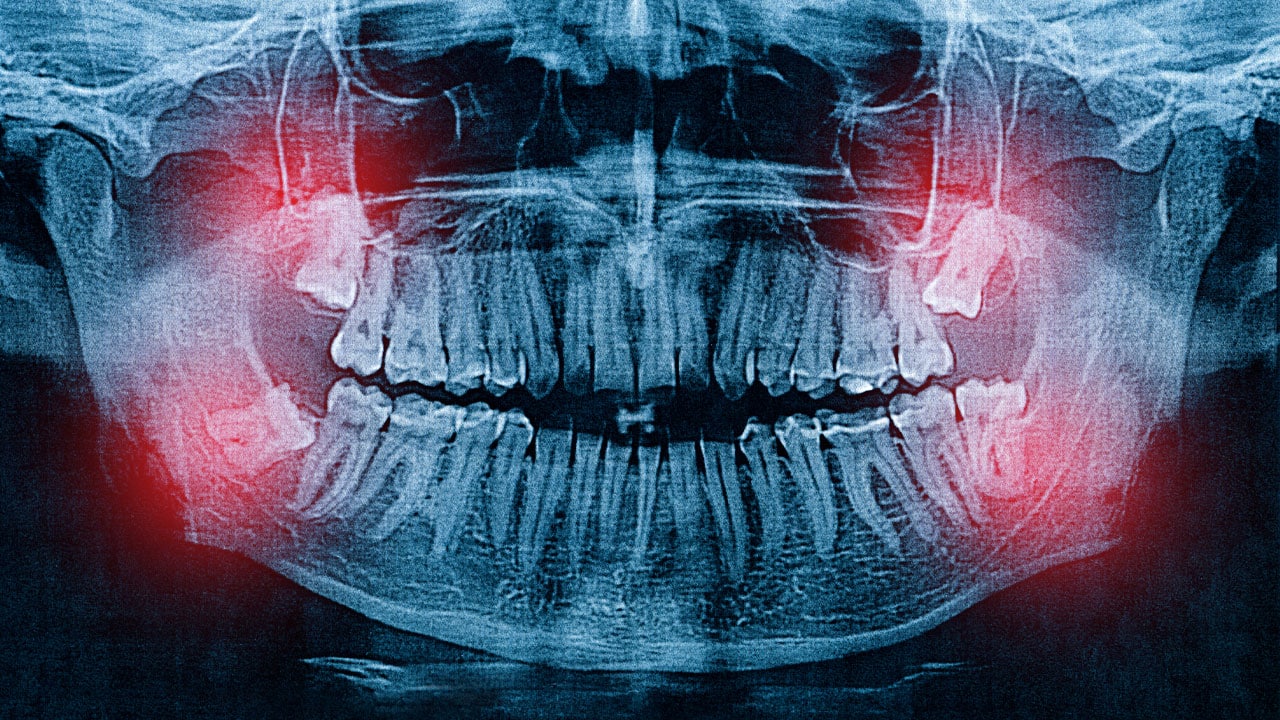 Dental x-ray of teeth needing extraction