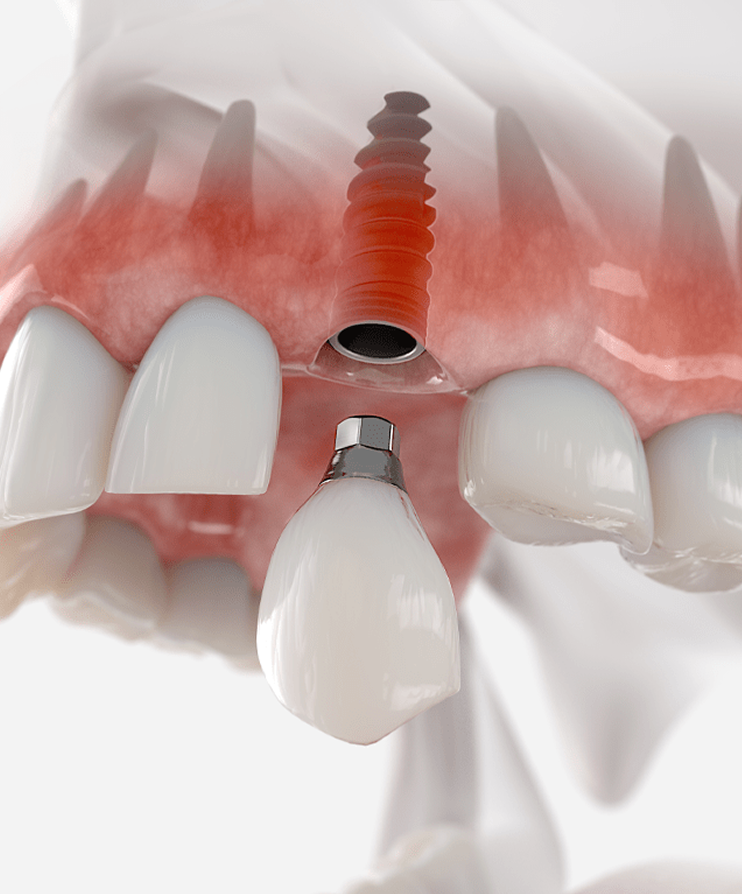 Dental implant procedure and tooth restoration