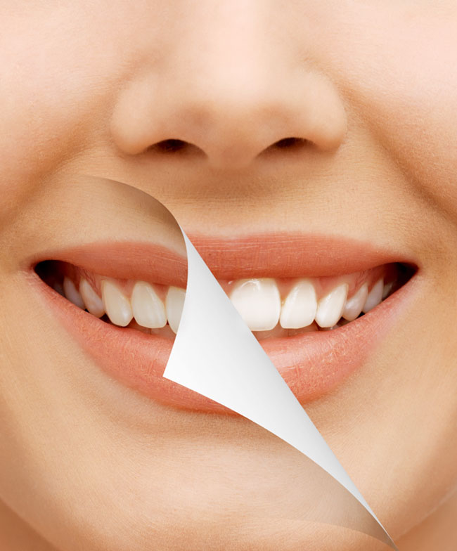Close-up of a woman’s smile showing before and after professional teeth whitening results