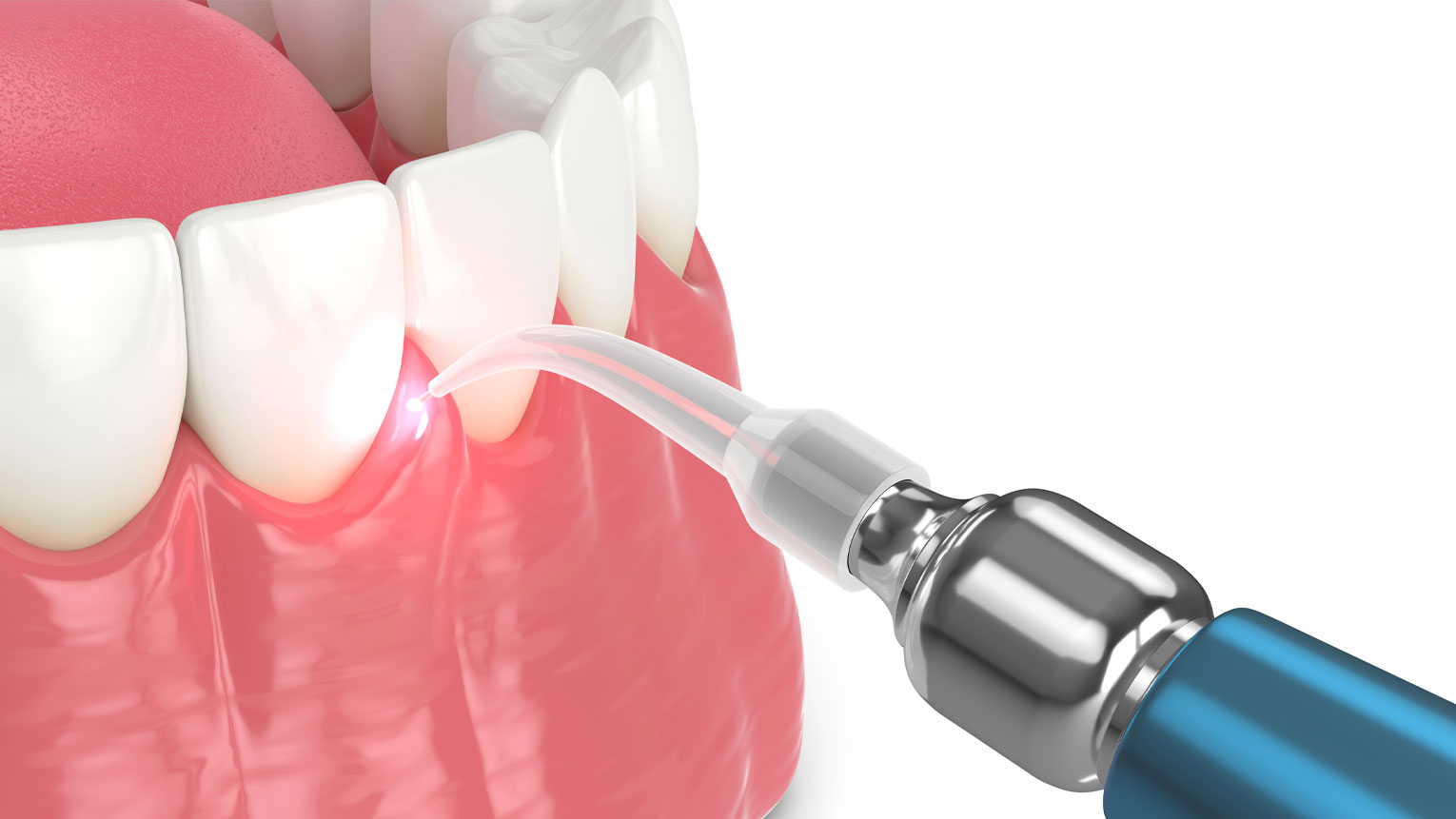 What Is Laser Dentistry And What Are The Benefits?